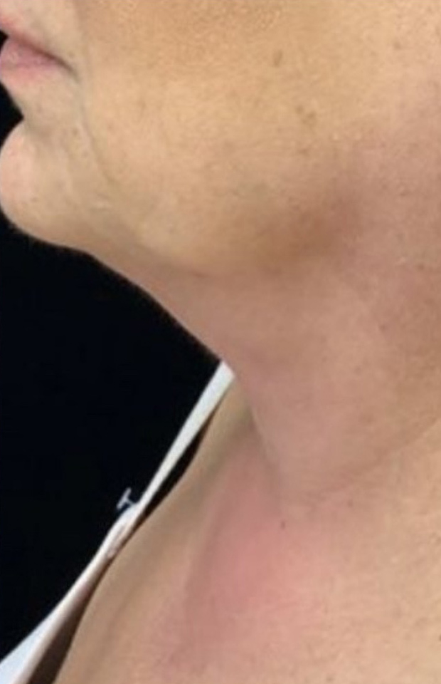 After Image: Exilis Ultra - left-side