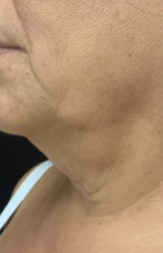 Before Image: Exilis Ultra - left-side