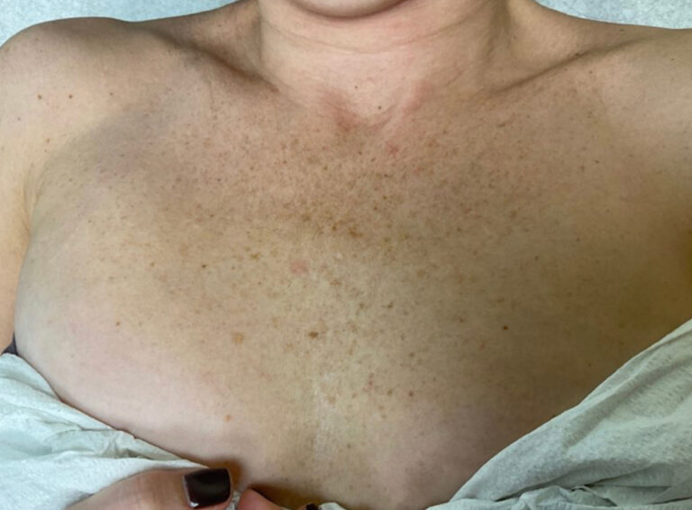 Before Image: IPL - front