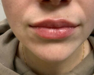 After Image: Lip Fillers
