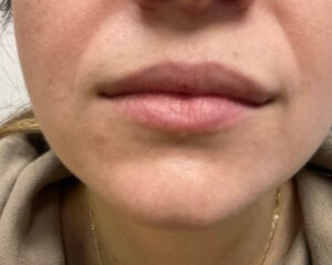 Before Image: Lip Fillers