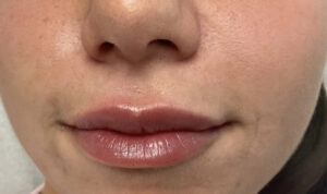 After Image: Lip Fillers
