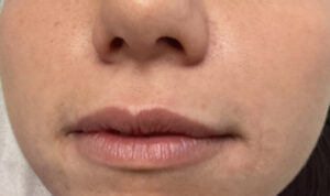 Before Image: Lip Fillers