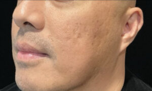 After Image: Secret RF Microneedling