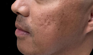 Before Image: Secret RF Microneedling