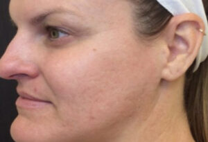 After Image: Secret RF Microneedling