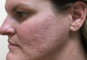 Before Image: Secret RF Microneedling