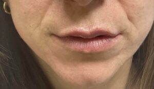 After Image: Lip Fillers