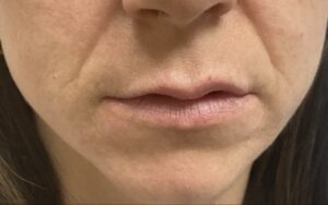 Before Image: Lip Fillers