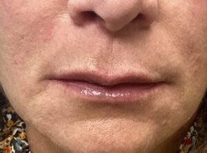 After Image: Lip Fillers